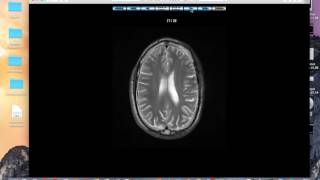 Haemosiderin staining brain MRI [upl. by Duncan508]