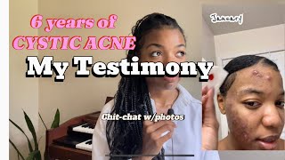 Clearing Cystic acne my testimony mini chitchat [upl. by Ansilma]