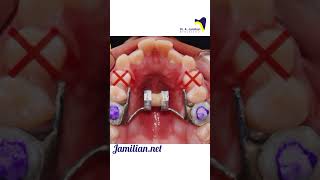 Maxillary expansion and upper first premolar extraction to relieve crowding orthodontics bracing [upl. by Hulburt323]