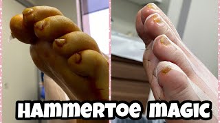 MINIMALLY INVASIVE HAMMERTOE SURGERY LIVE PROCEDURES 😍 [upl. by Obeng991]