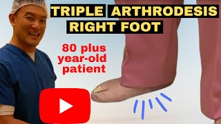 80 plus year old with triple arthrodesis on the right foot by Dr Kevin Lam toppodiatrist [upl. by Cornelia]