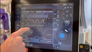 Het berekenen van de occlusie druk en predicted transpulmonaal druk ServoU [upl. by Ryan971]