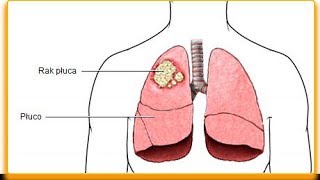 Jak się objawia rak płuc — objawy które powinieneś znać [upl. by Leanor]