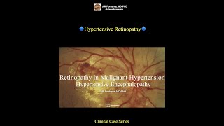 Hypertensive Retinopathy Hypertensive Encephalopathy [upl. by Linden151]