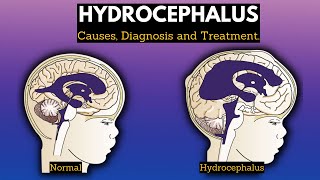 Hydrocephalus Causes Signs and Symptoms Diagnosis and Treatment [upl. by Audly]