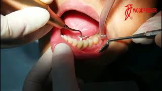 Tips of Periodontal Treatment Device P90 [upl. by Natividad]