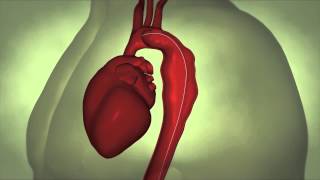 What is an abdominal aortic aneurysm [upl. by Hsetih772]