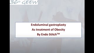 Endoluminal gastroplasty as treatment of obesity by Endo StitchTM [upl. by Ezarra984]