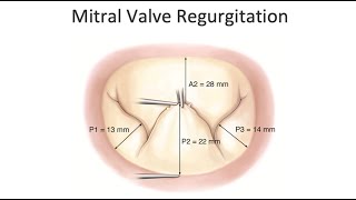 Understanding Mitral Regurgitation with Dr Patrick McCarthy [upl. by Desiree]