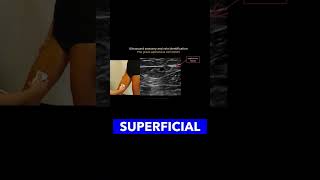 Identifying the Great Saphenous Vein vascularultrasound healthcareexcellence MedicalEducation [upl. by Lisbeth]