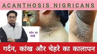 गर्दन कांख और चेहरे का कालापन  गर्दन पर मस्से  Acanthosis Nigricans skintag acanthosisNigricans [upl. by Sorilda]