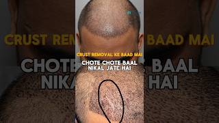 Losing hair during crust removal after hair transplant Is it Normal  Explained by Dr Jangid [upl. by Nibroc]