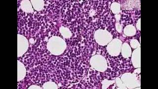 Histopathology BoneMultiple myeloma [upl. by Eecrad345]