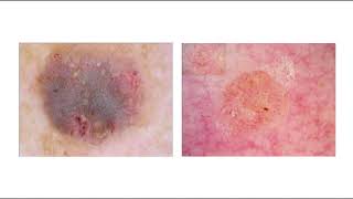 Tema 9 Dermatoscopia de la queratosis seborreica [upl. by Macdermot]