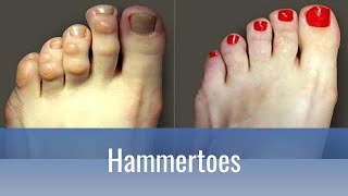 Hammertoes Why do they hurt and how to fix them [upl. by Madison65]