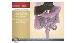 ColostomyIleostomy Your Operation [upl. by Ellerahc]