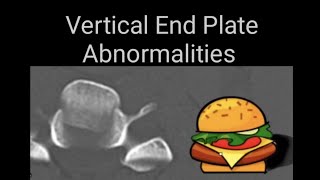 Vertibral end plates abnormalities on lumbosacral spine x rays and CT images [upl. by Akirehs408]