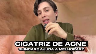 Cicatriz de acne Será que a skincare consegue te ajudar Vem saber quais as minhas dicas skincare [upl. by Litha]