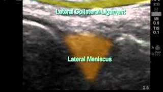 How To Lateral Meniscus Ultrasound Exam [upl. by Scuram]