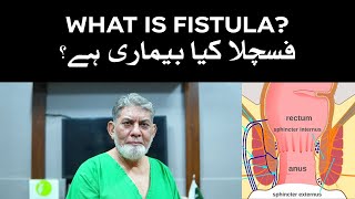 What is Fistula Information for a common man [upl. by Jabin391]