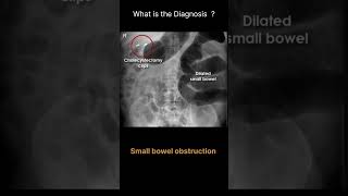 Small bowel obstruction Abdominal Xray  Abnormalities Normal reference 64 radiologychannel007 [upl. by Notxam]