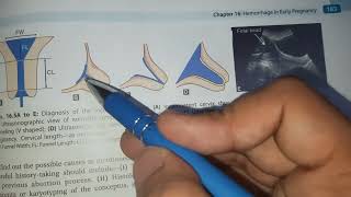 Recurrent Miscarriage 2 Cervical Incompetence Investigations Treatment of Recurrent Miscarriage [upl. by Schultz]