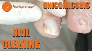 Big toe cleaning podology asmr [upl. by Odidnac]