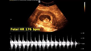 Single viable pregnancy of 11 weeks 02 day  Normal Pregnancy [upl. by Arannahs]