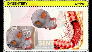 dysentery  pichesh  अतिसार [upl. by Tawney]
