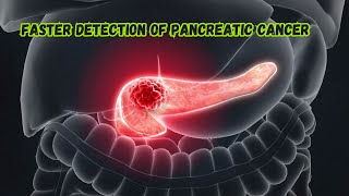 Faster detection of pancreatic cancer [upl. by Ecinna]