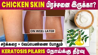 Affected By Keratosis Pilaris Disease  Home Remedies To Cure Chicken Skin  IBC Mangai [upl. by Feledy]