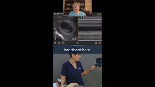 How to measure the fetal heart rate with US [upl. by Olraced]