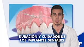 Cómo CUIDAR los IMPLANTES dentales ¿Cuánto pueden durar  Shorts [upl. by Ainoek506]