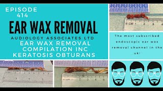 EAR WAX REMOVAL COMPILATION INC KERATOSIS OBTURANS  EP414 [upl. by Yarahs]