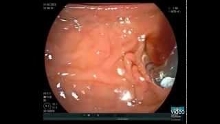 Primary Sclerosing Cholangitis and Brush Cytology Sampling [upl. by Mell]