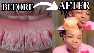 How to Get Rid of CHAPPEDDRY and CRACKED Lips FAST [upl. by Uria52]