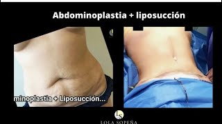 Abdominoplastia con liposucción [upl. by Giovanni132]