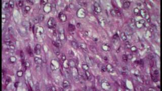 Epithelioid Sarcoma [upl. by Cammy369]