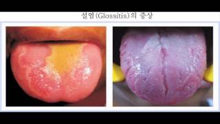 설염 glossitis  최신치료법 [upl. by Shamma]