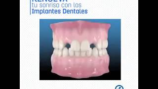 CLÍNICA DENTAL FLORES  RENUEVA TU SONRISA [upl. by Towny663]