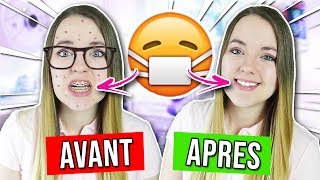 AVOIR UN APPAREIL DENTAIRE  AVANT VS APRES [upl. by Cleopatre510]