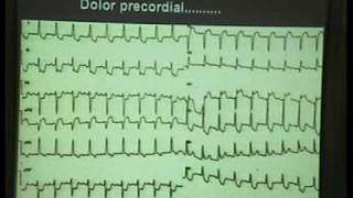 Curso ECG 2010  01 Fibrilación Ventricular [upl. by Jehiah]