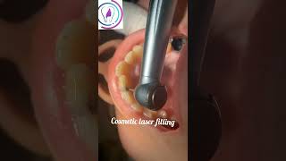 Central incisor cosmetic filling dentist dentalclinic toothdental [upl. by Htiaf]