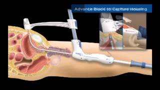 TSPeC® Illustrated Procedure  German [upl. by Enilrek696]