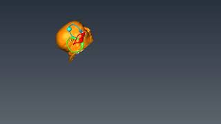 Casani Maneuver for Anterior Canalithiasis Teixido HD [upl. by Simetra783]