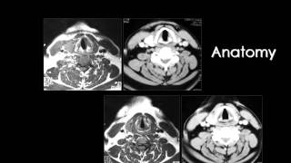 Radiology  Imaging of Larynx  Head and Neck [upl. by Achilles98]