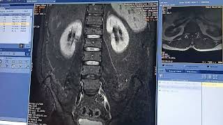 MRI Lumber spine Fracture on L1 And L2 knowledge radiology [upl. by Disharoon]