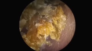 Satisfying Ear Wax Removal With Dokter Tht [upl. by Giliana468]