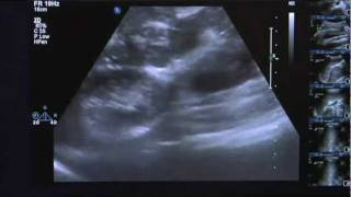 Ultrasound Training Gastrointestinal Tract [upl. by Basir]