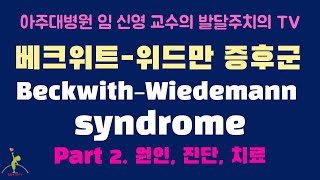 155 베크위트위드만 증후군 BeckwithWiedemann syndrome 2편 원인 진단 치료 [upl. by Edgerton]